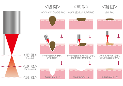 炭酸ガスレーザーのメカニズム
