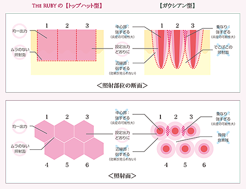 Qスイッチ・ルビーレーザー The Ruby Z1